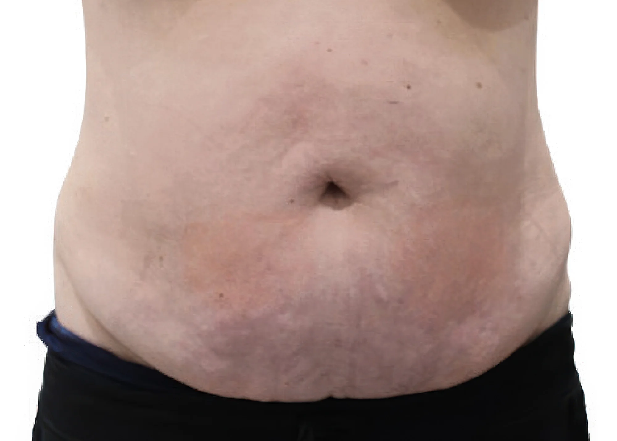 Before and after treatment results photos at The Face & Body MediSpa of 3D Lipo Ultimatepro body treatment