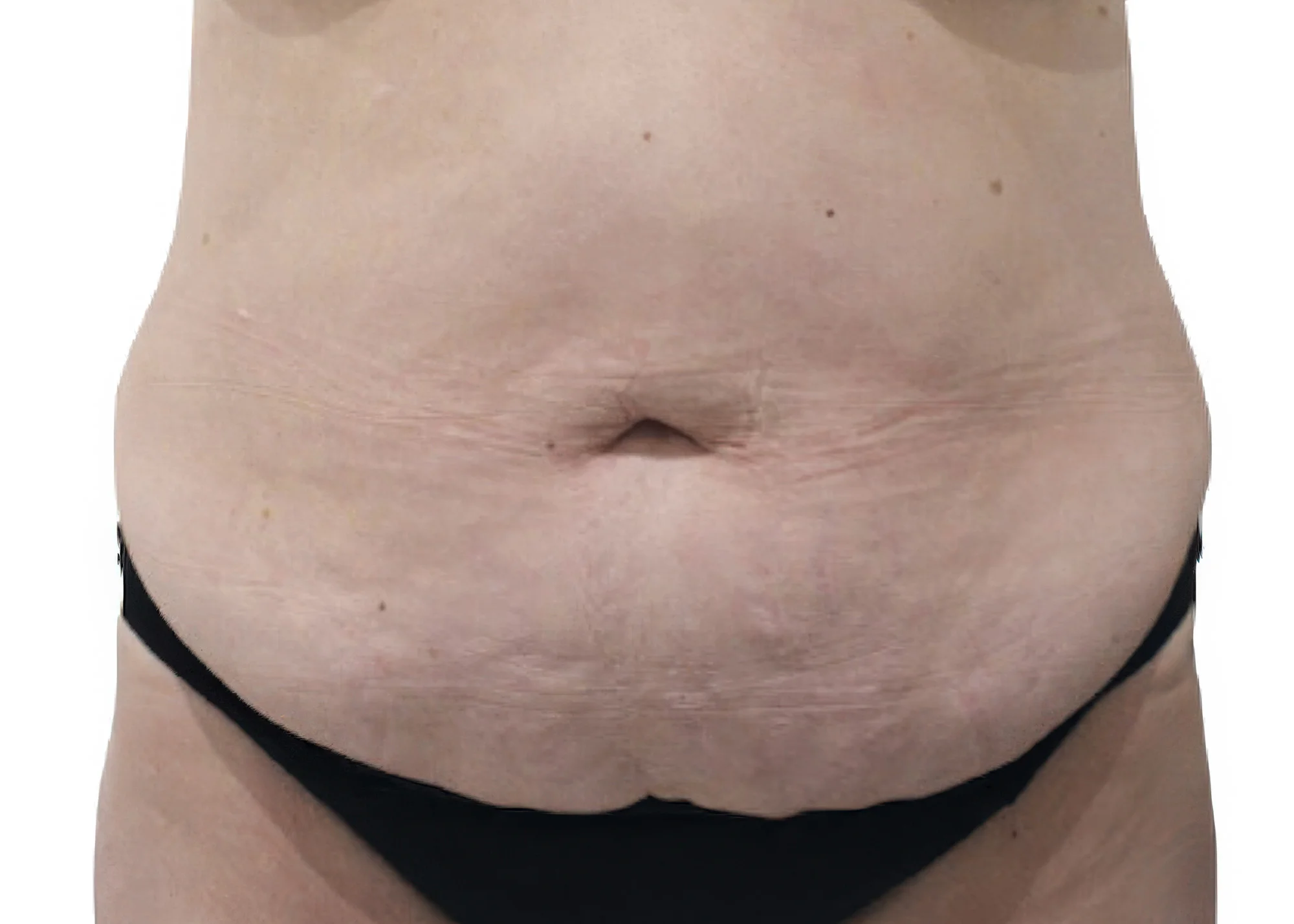 Before and after treatment results photos at The Face & Body MediSpa of 3D Lipo Ultimatepro body treatment