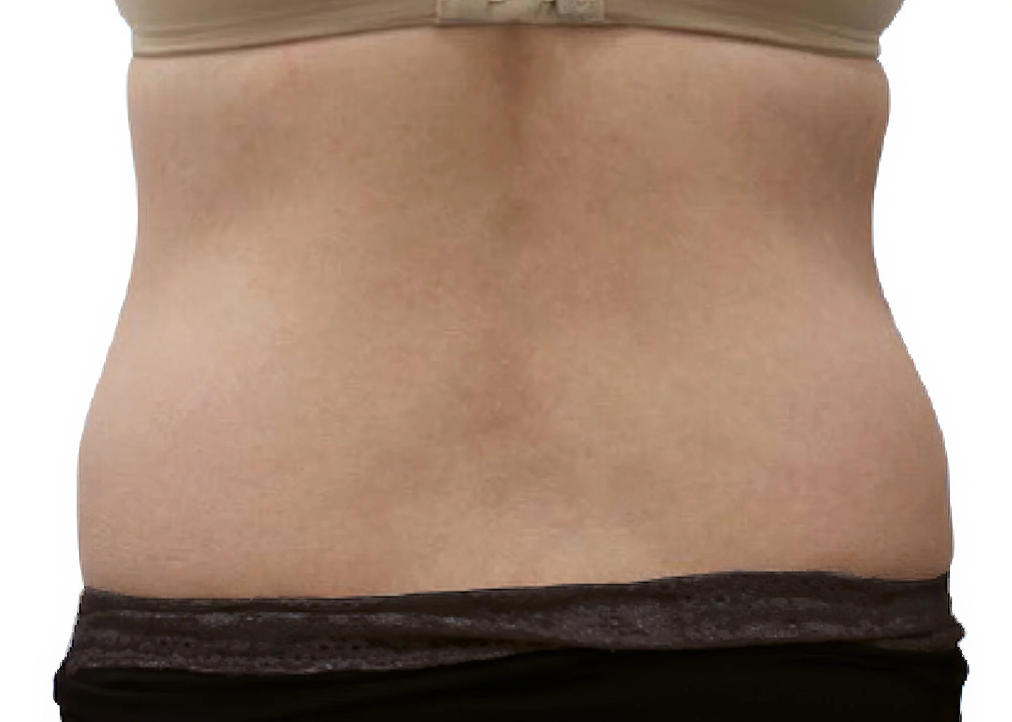 Before and after treatment results photos at The Face & Body MediSpa of 3D Lipo Ultimatepro body treatment