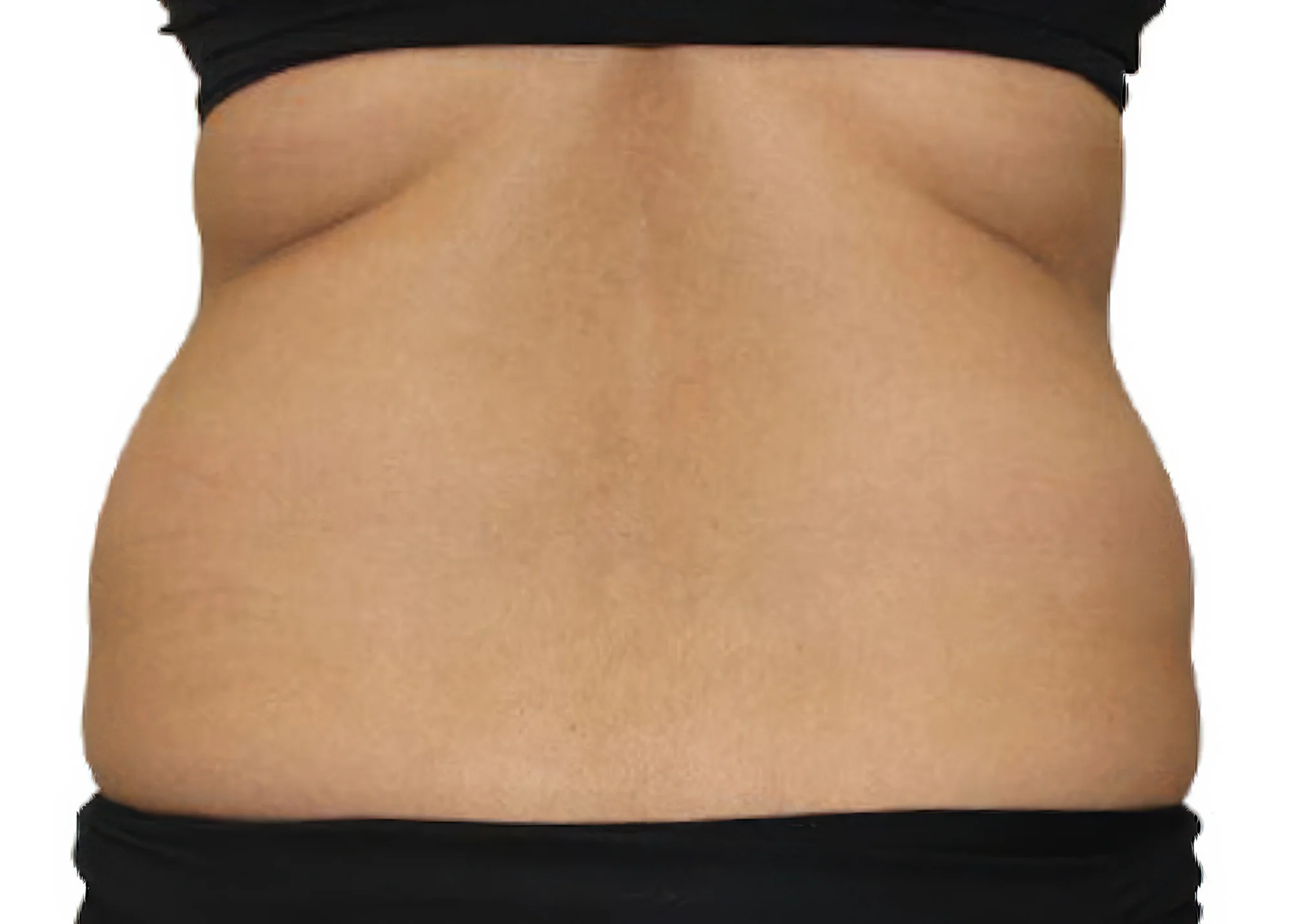 Before and after treatment results photos at The Face & Body MediSpa of 3D Lipo Ultimatepro body treatment