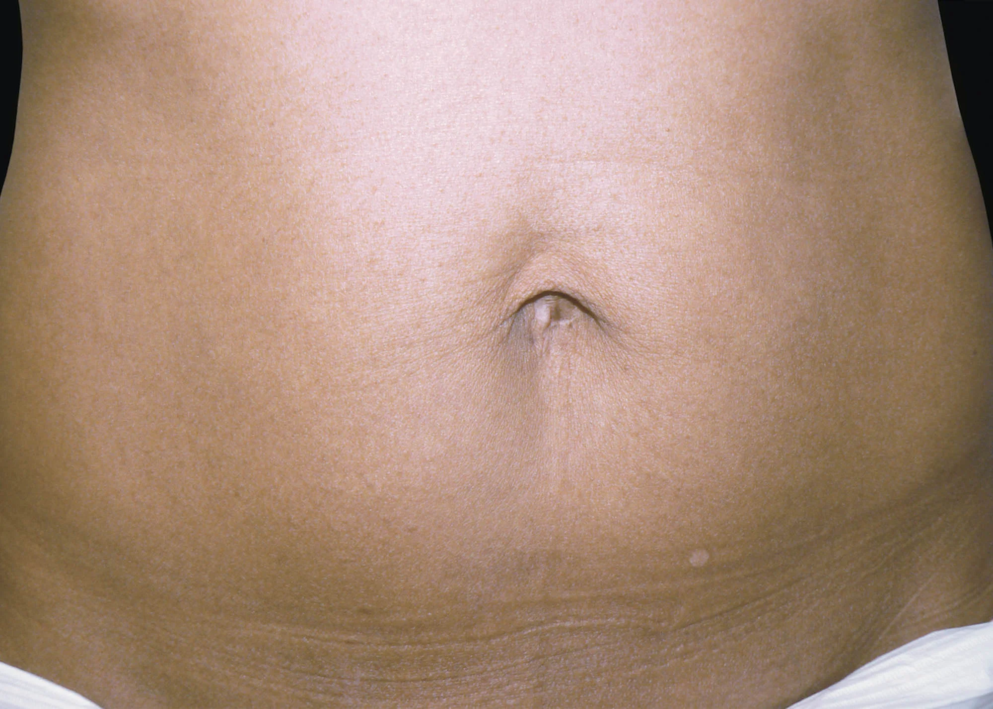 Before and after treatment results photos at The Face & Body MediSpa of BTL Exilis Ultra 360 Body Treatment