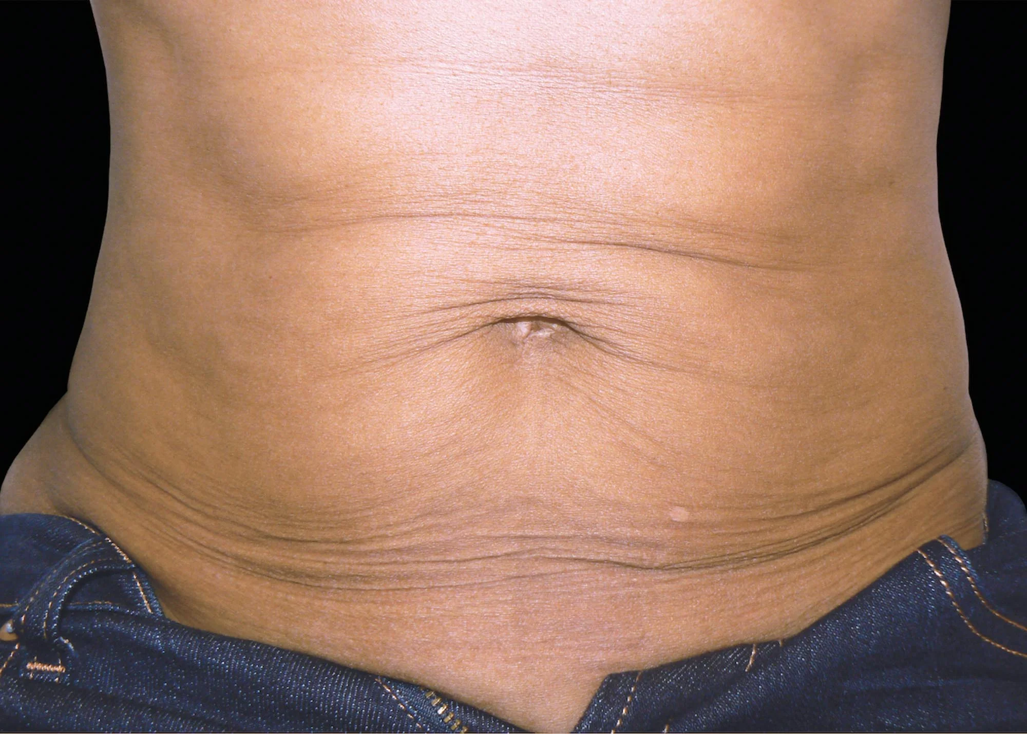 Before and after treatment results photos at The Face & Body MediSpa of BTL Exilis Ultra 360 Body Treatment