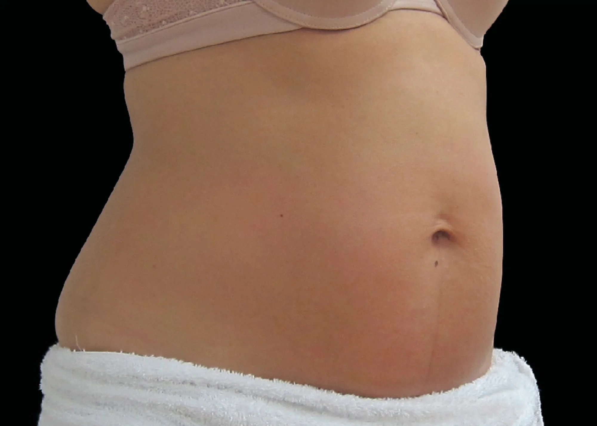 Before and after treatment results photos at The Face & Body MediSpa of BTL Exilis Ultra 360 Body Treatment
