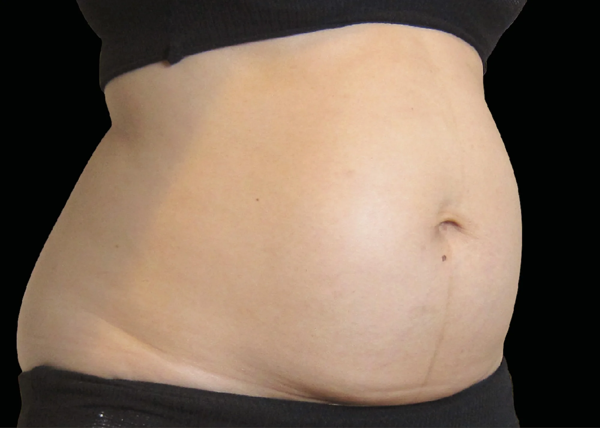 Before and after treatment results photos at The Face & Body MediSpa of BTL Exilis Ultra 360 Body Treatment