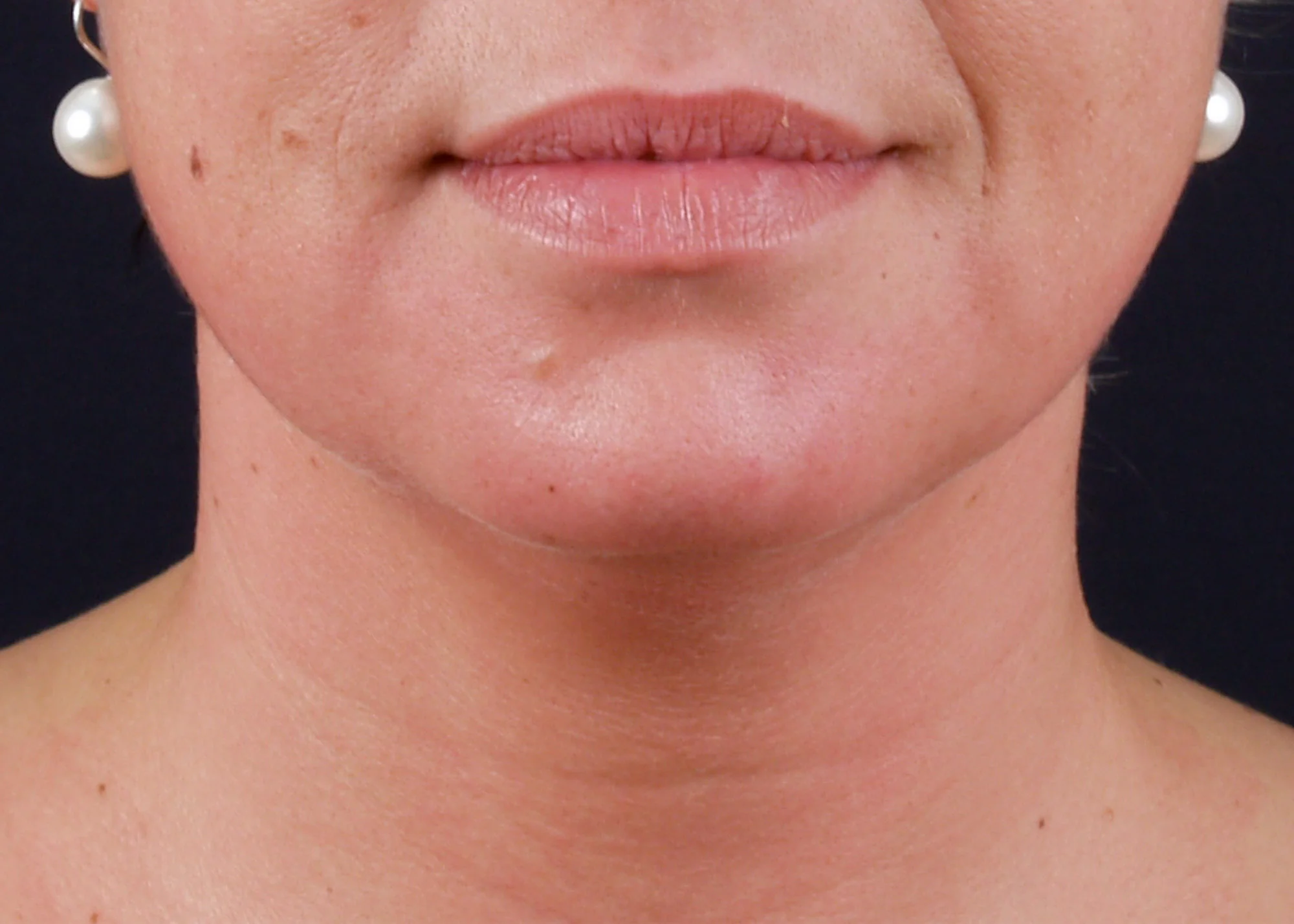 Before and after treatment results photos at The Face & Body MediSpa of BTL Exilis Ultra 360 Face Treatment