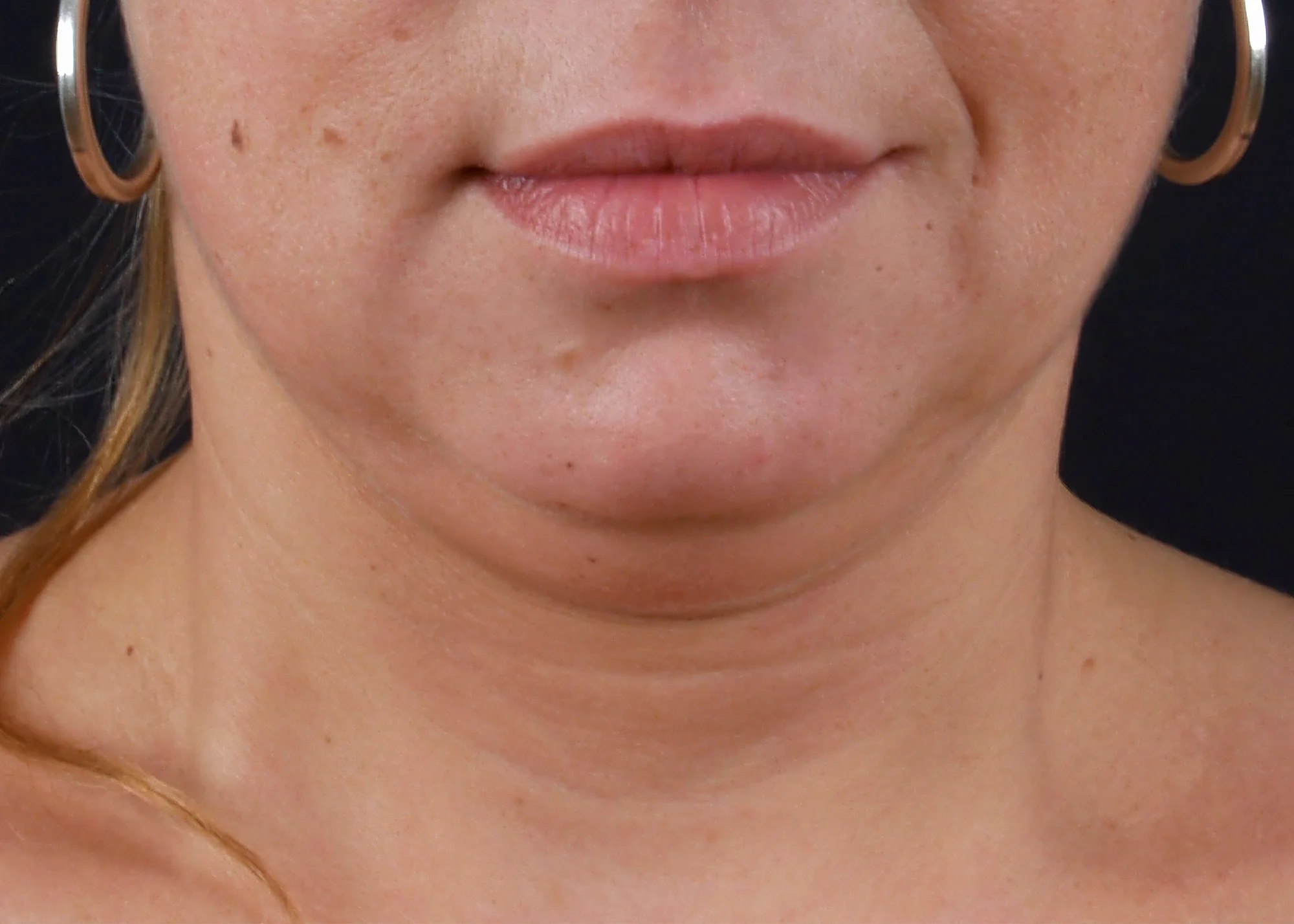 Before and after treatment results photos at The Face & Body MediSpa of BTL Exilis Ultra 360 Face Treatment