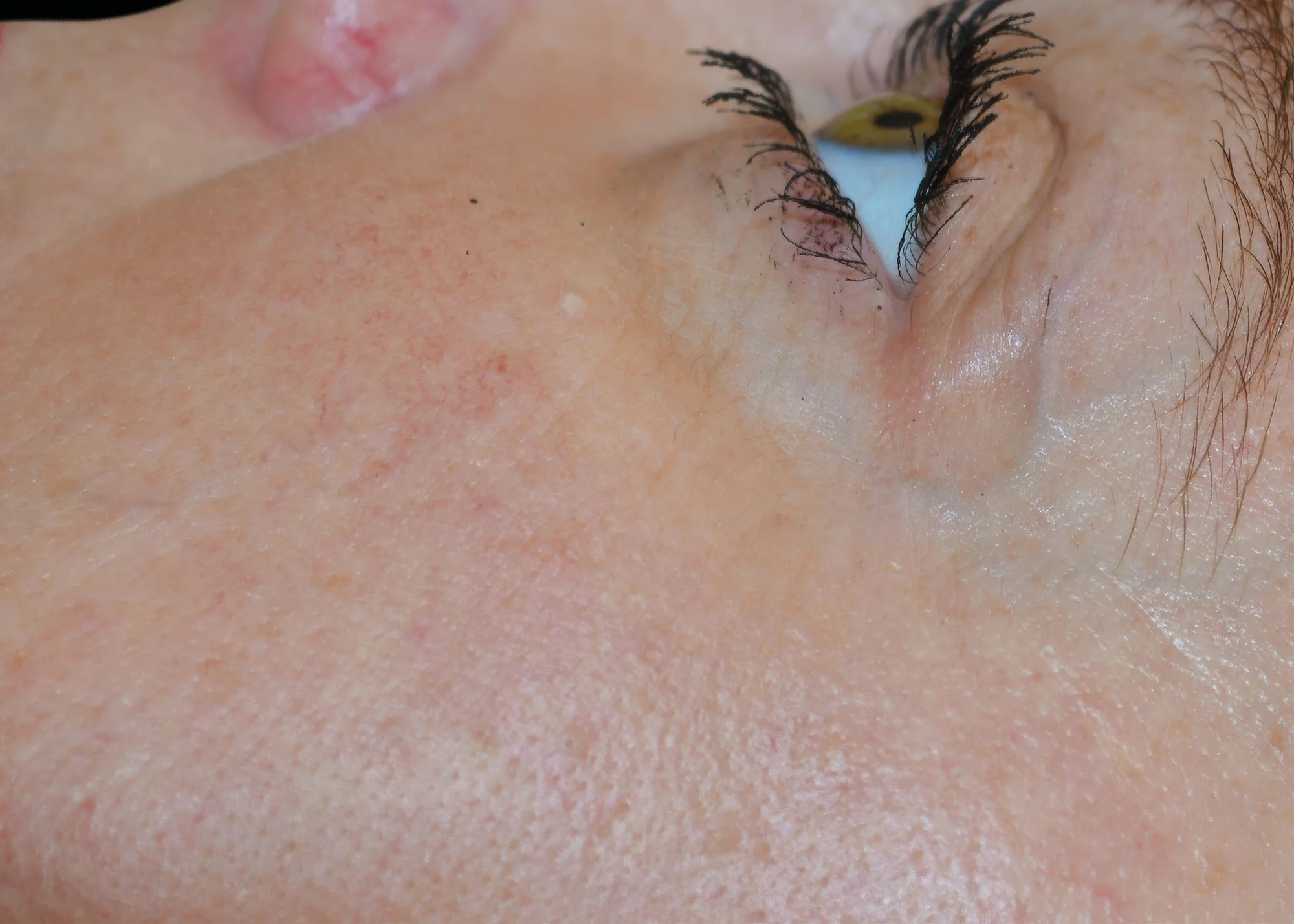 Before and after treatment results photos at The Face & Body MediSpa of BTL Exilis Ultra 360 Face Treatment