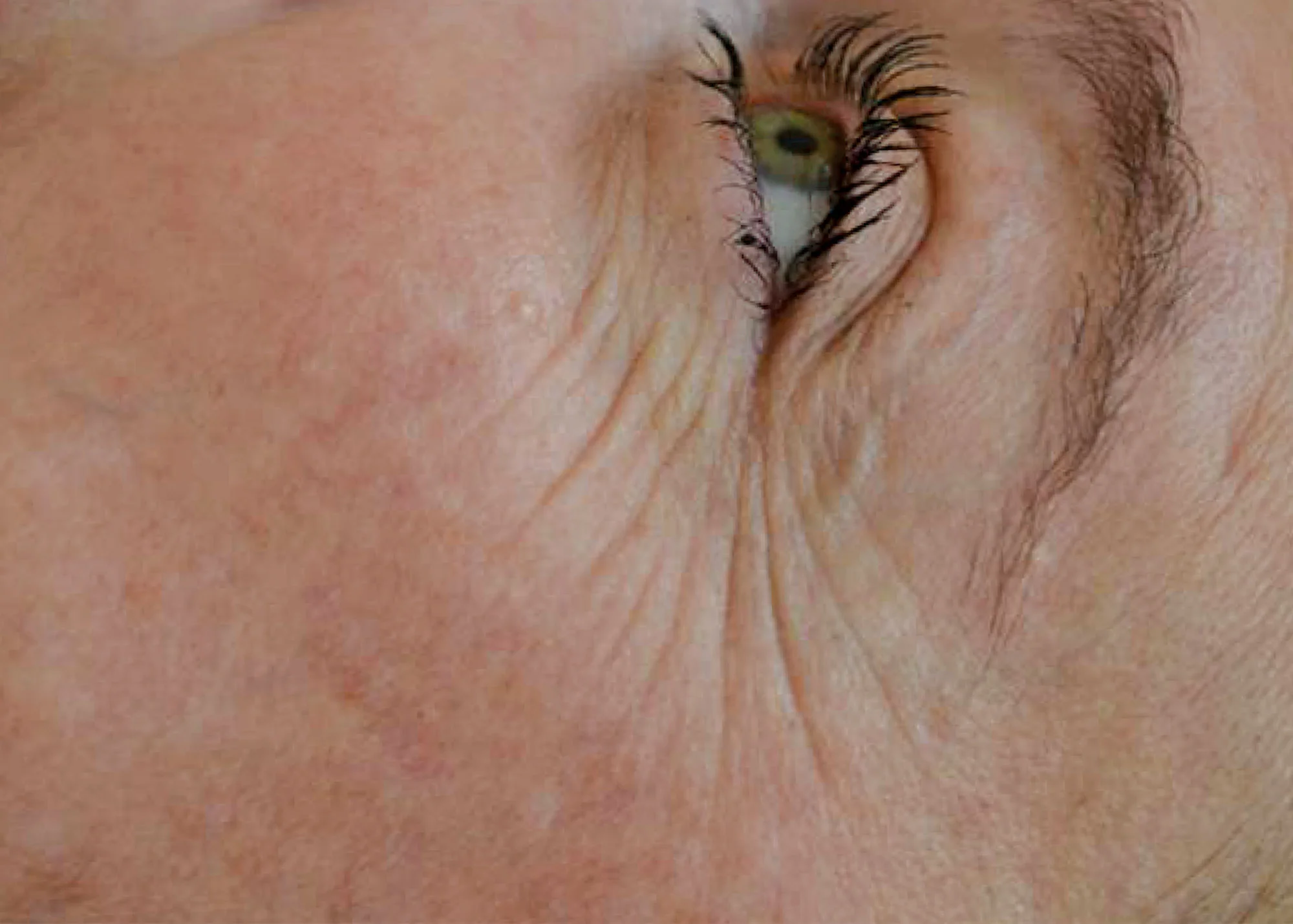 Before and after treatment results photos at The Face & Body MediSpa of BTL Exilis Ultra 360 Face Treatment