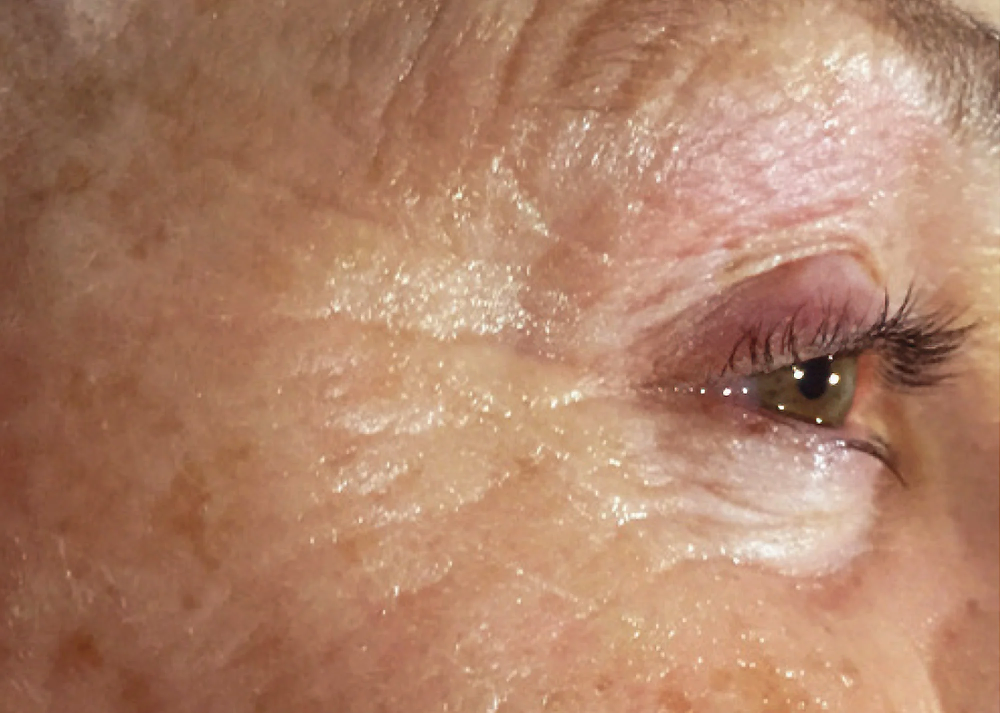 Before and after treatment results photos at The Face & Body MediSpa of CACI Eve Revive treatment