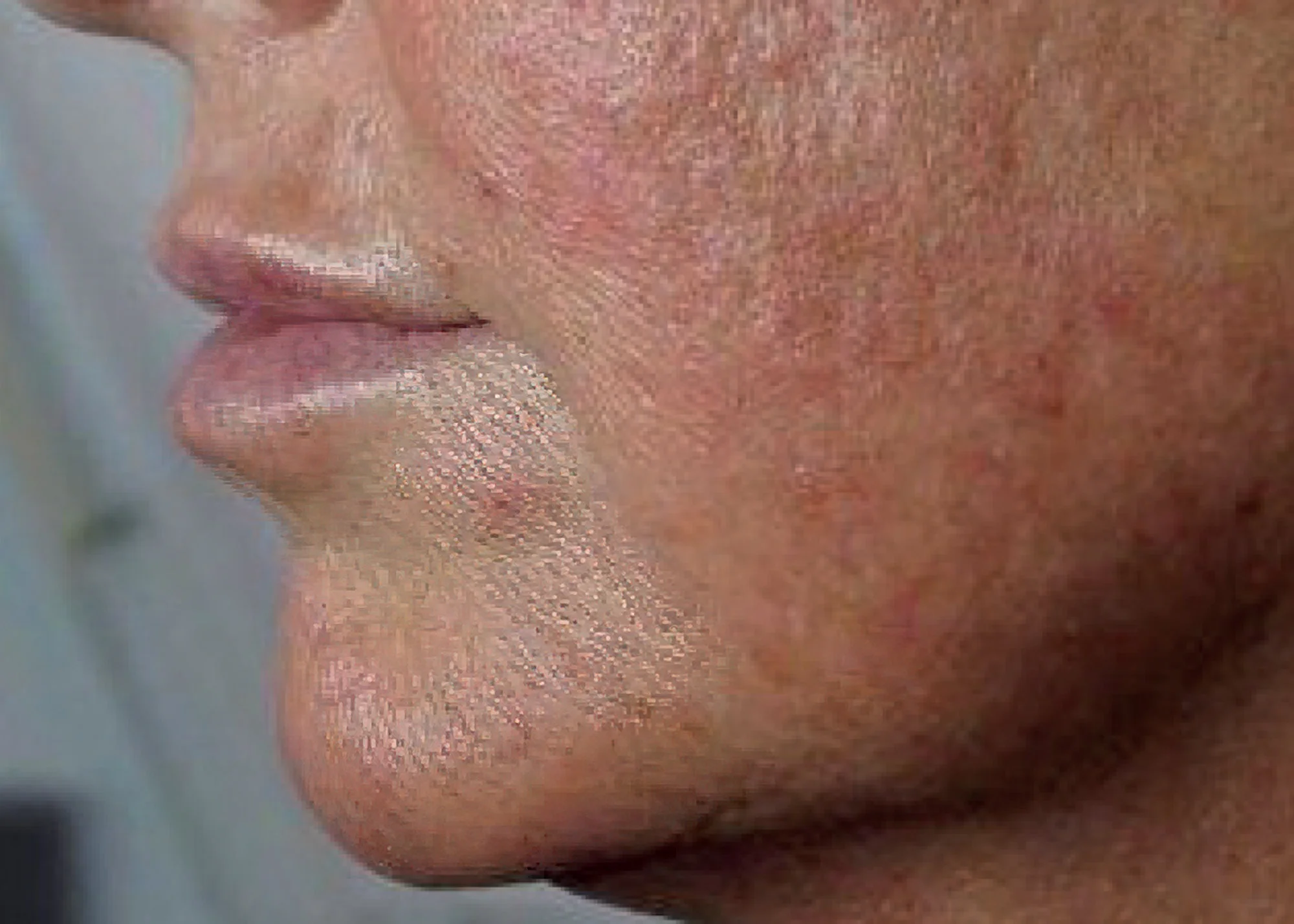 Before and after treatment results photos at The Face & Body MediSpa of CACI Jowl Lift treatment