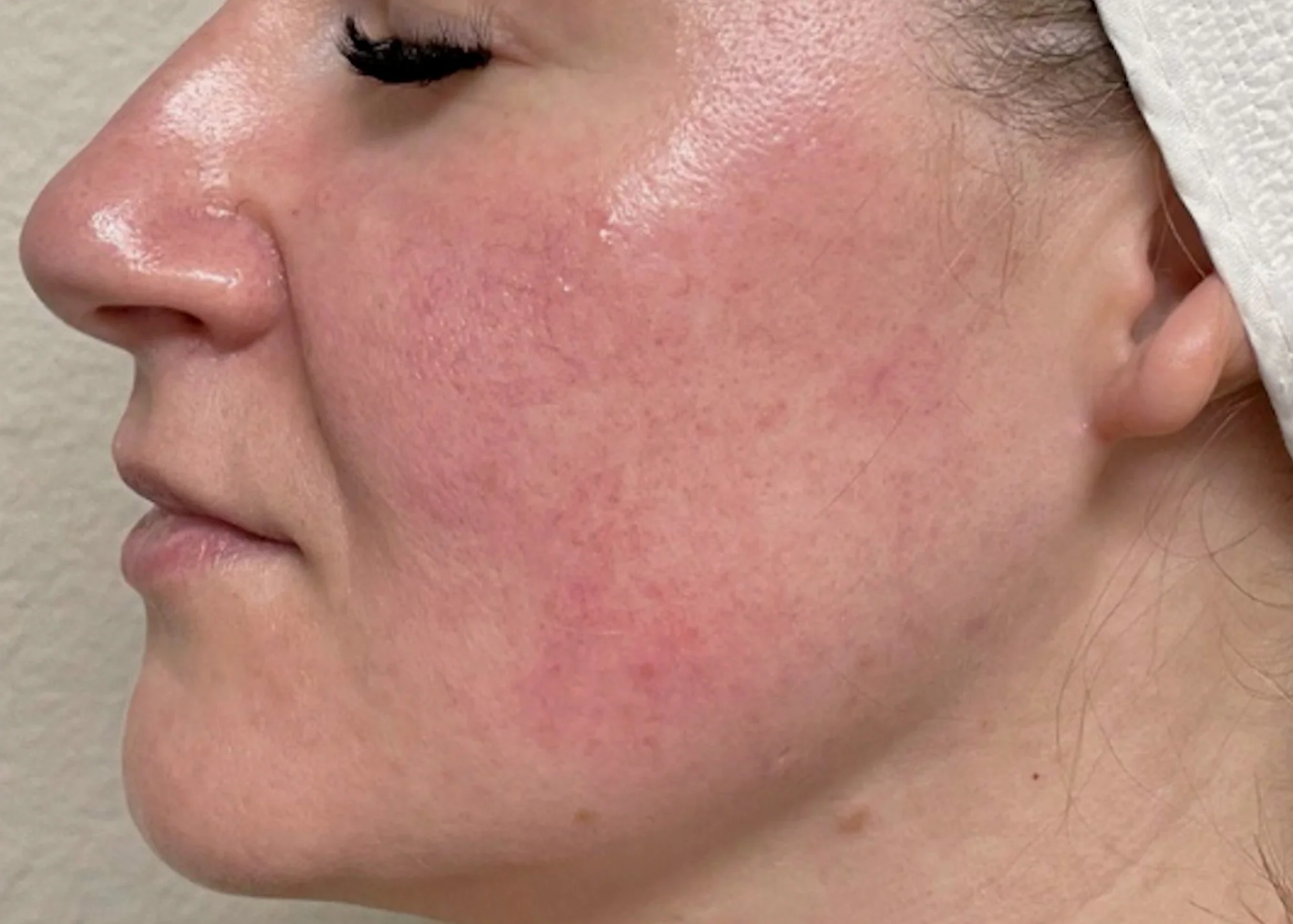 Before and after treatment results photos at The Face & Body MediSpa of CACI Signature Non-Surgical Facial Toning Treatment