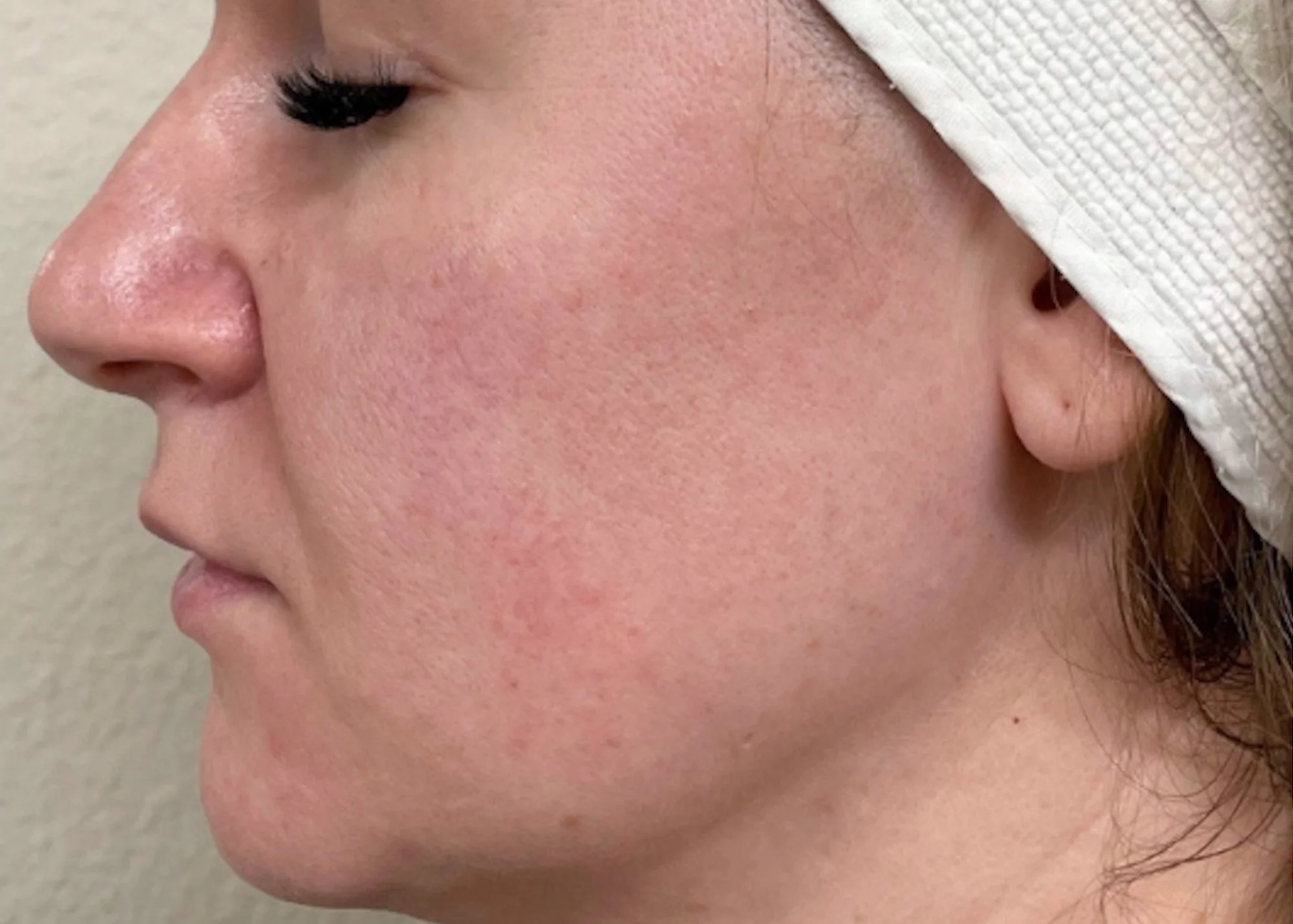 Before and after treatment results photos at The Face & Body MediSpa of CACI Signature Non-Surgical Facial Toning Treatment