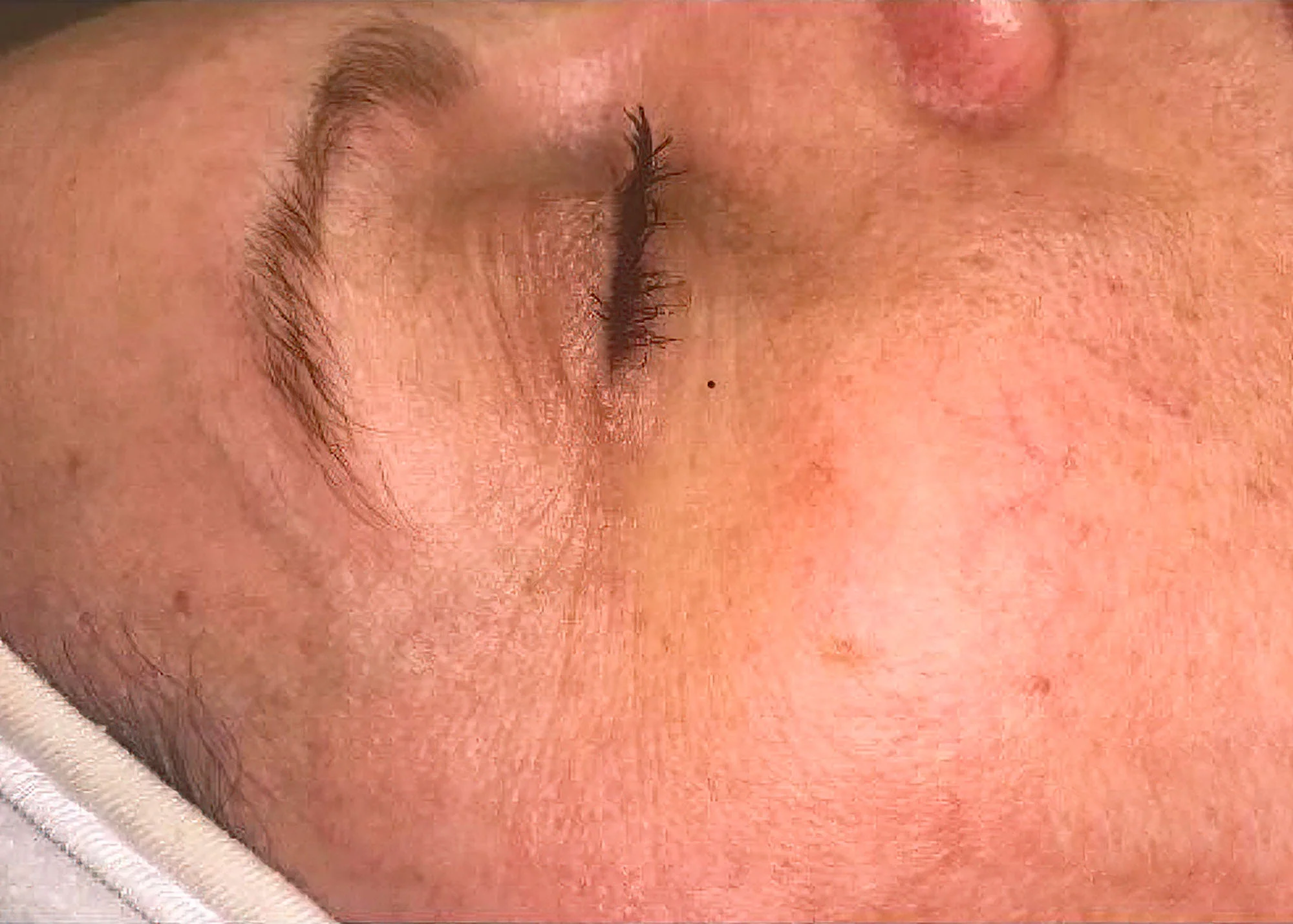 Before and after treatment results photos at The Face & Body MediSpa of Celluma LED Phototherapy