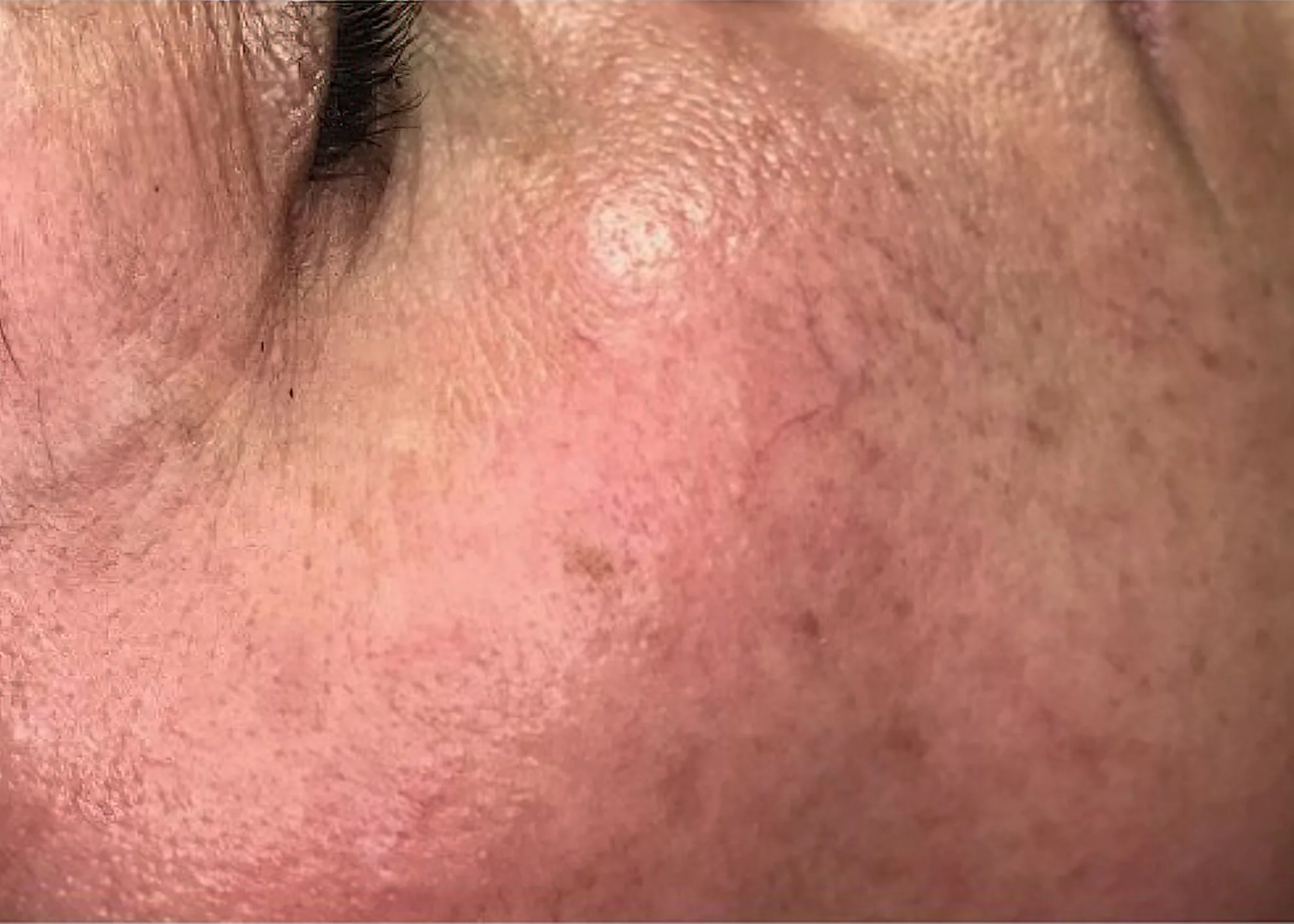 Before and after treatment results photos at The Face & Body MediSpa of Celluma LED Phototherapy