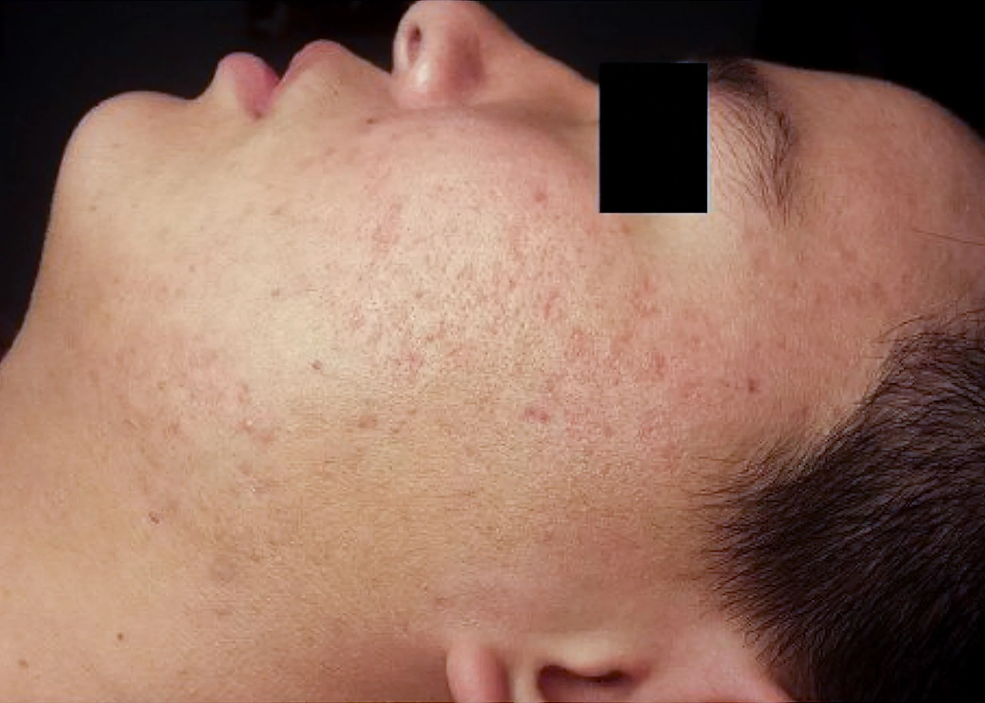 Before and after treatment results photos at The Face & Body MediSpa of Celluma LED Phototherapy