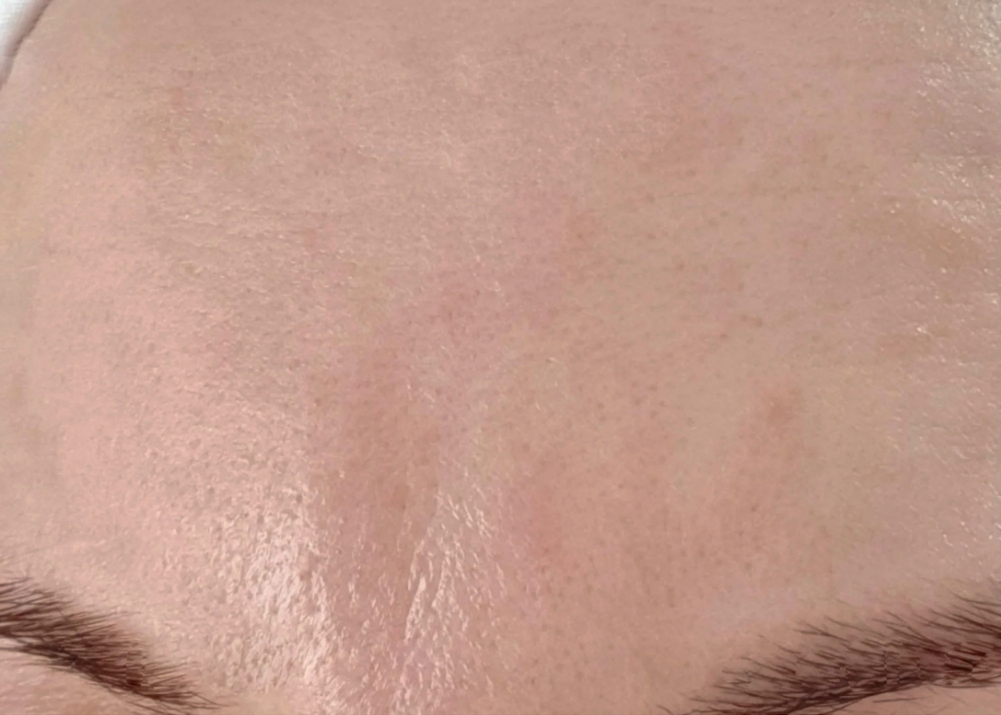 Before and after treatment results photos at The Face & Body MediSpa of Dermapen 4 Microneedling treatment
