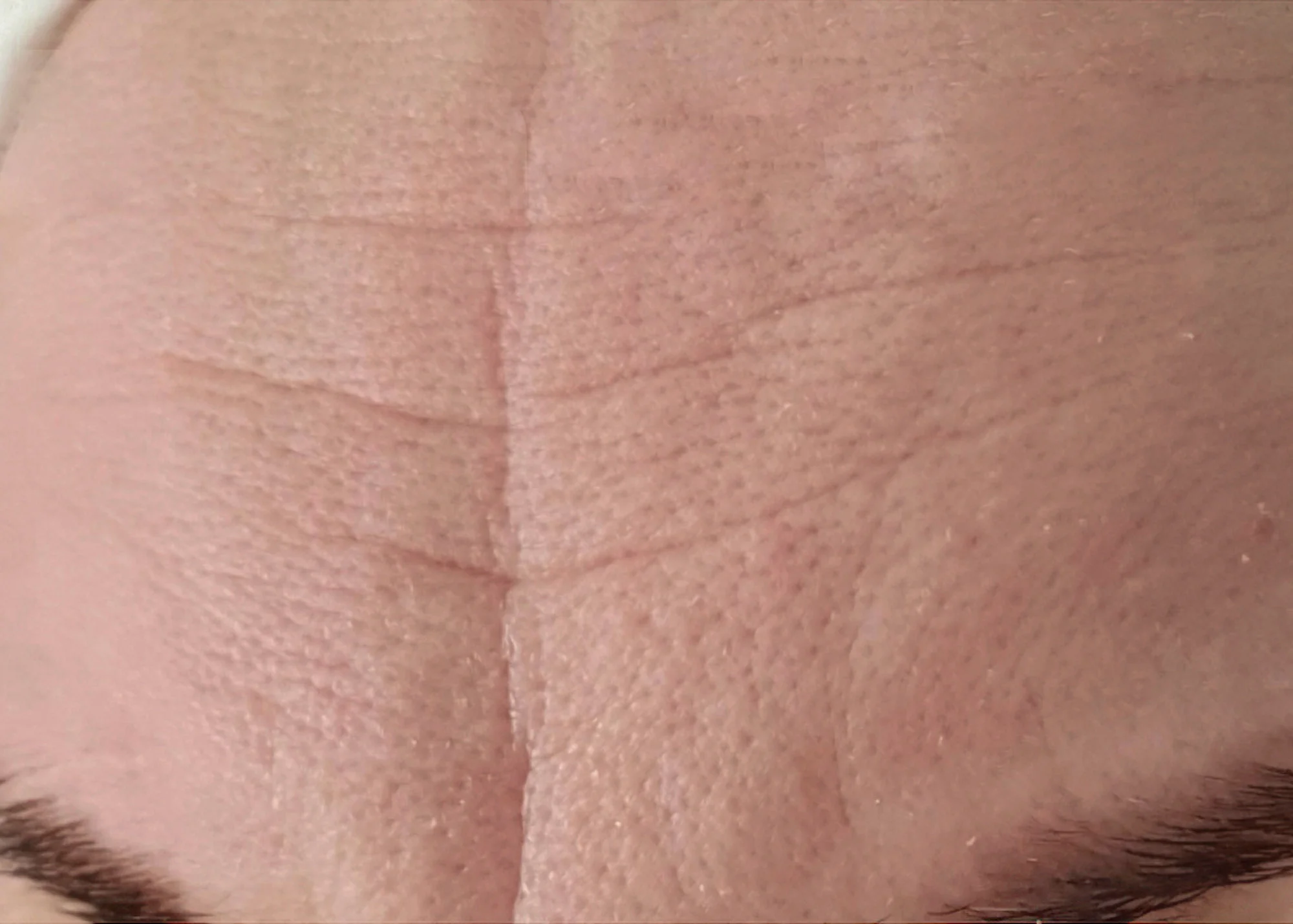 Before and after treatment results photos at The Face & Body MediSpa of Dermapen 4 Microneedling treatment