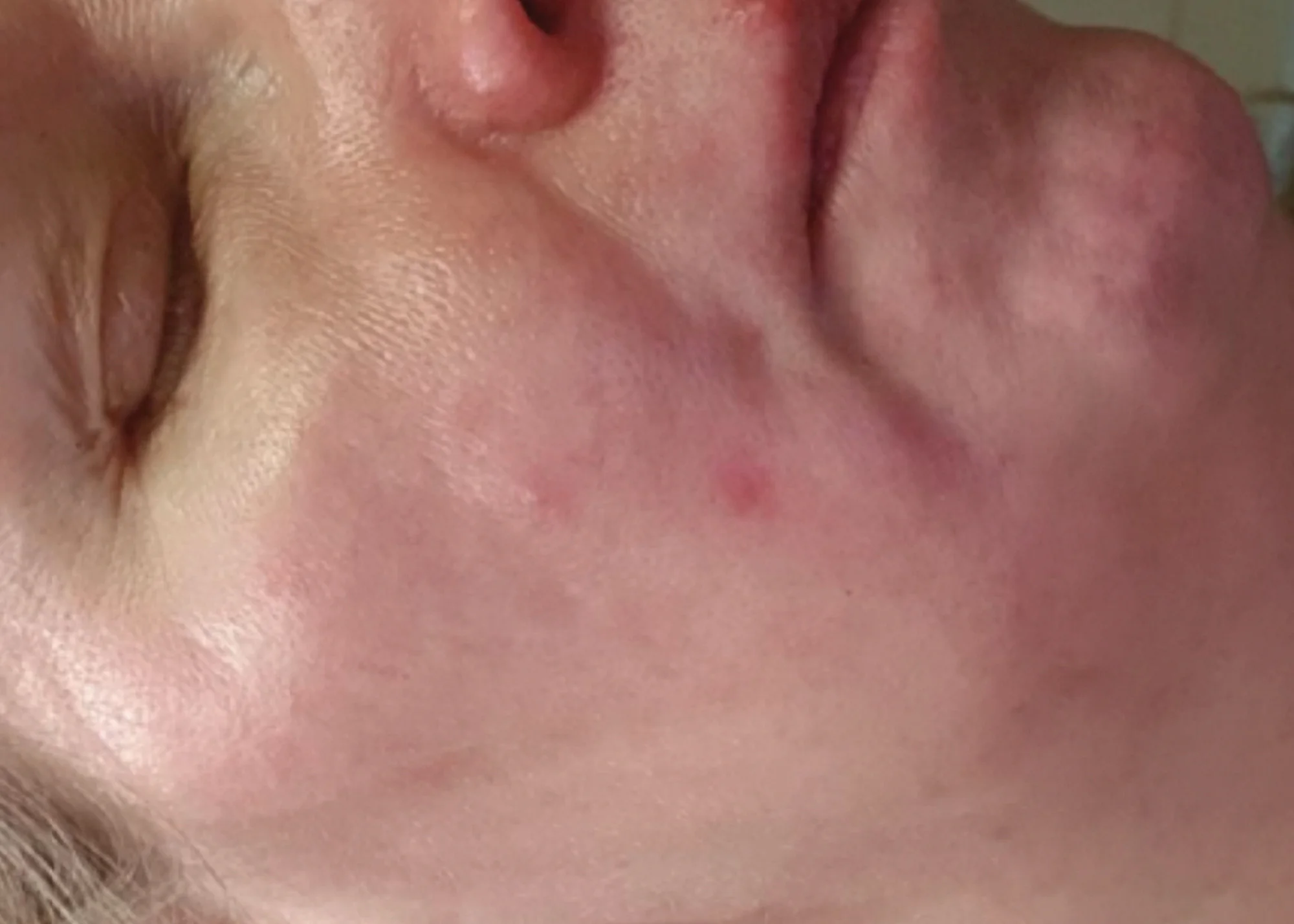 Before and after treatment results photos at The Face & Body MediSpa of Dermapen 4 Microneedling treatment