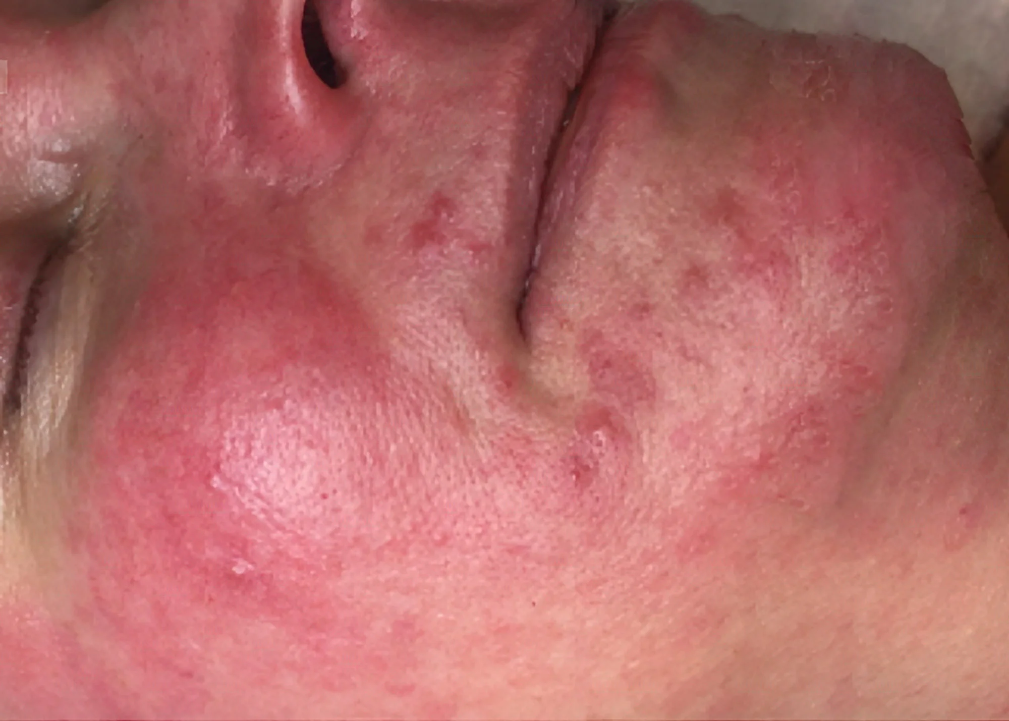 Before and after treatment results photos at The Face & Body MediSpa of Dermapen 4 Microneedling treatment