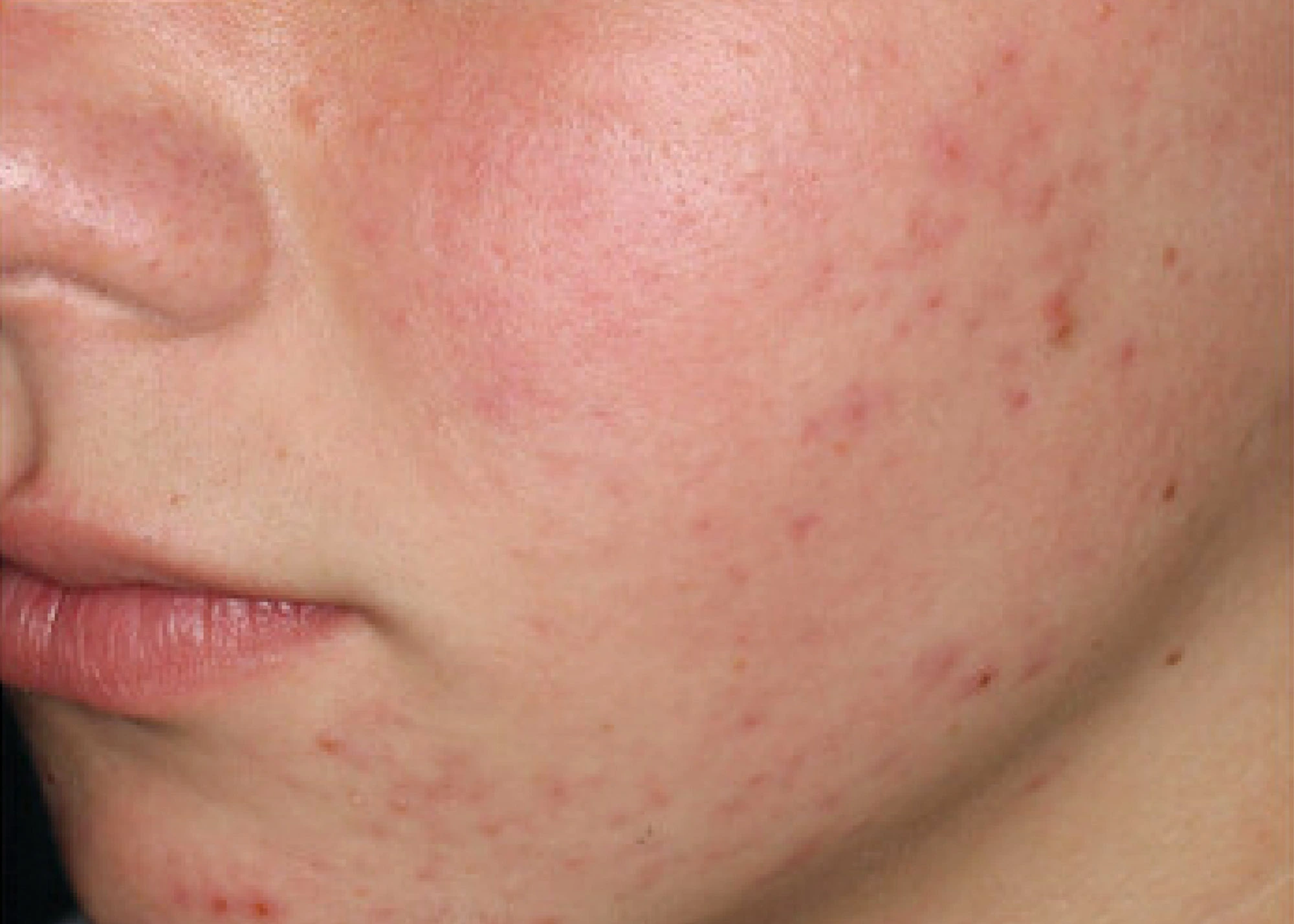 Before and after treatment results photos at The Face & Body MediSpa of Environ treatment