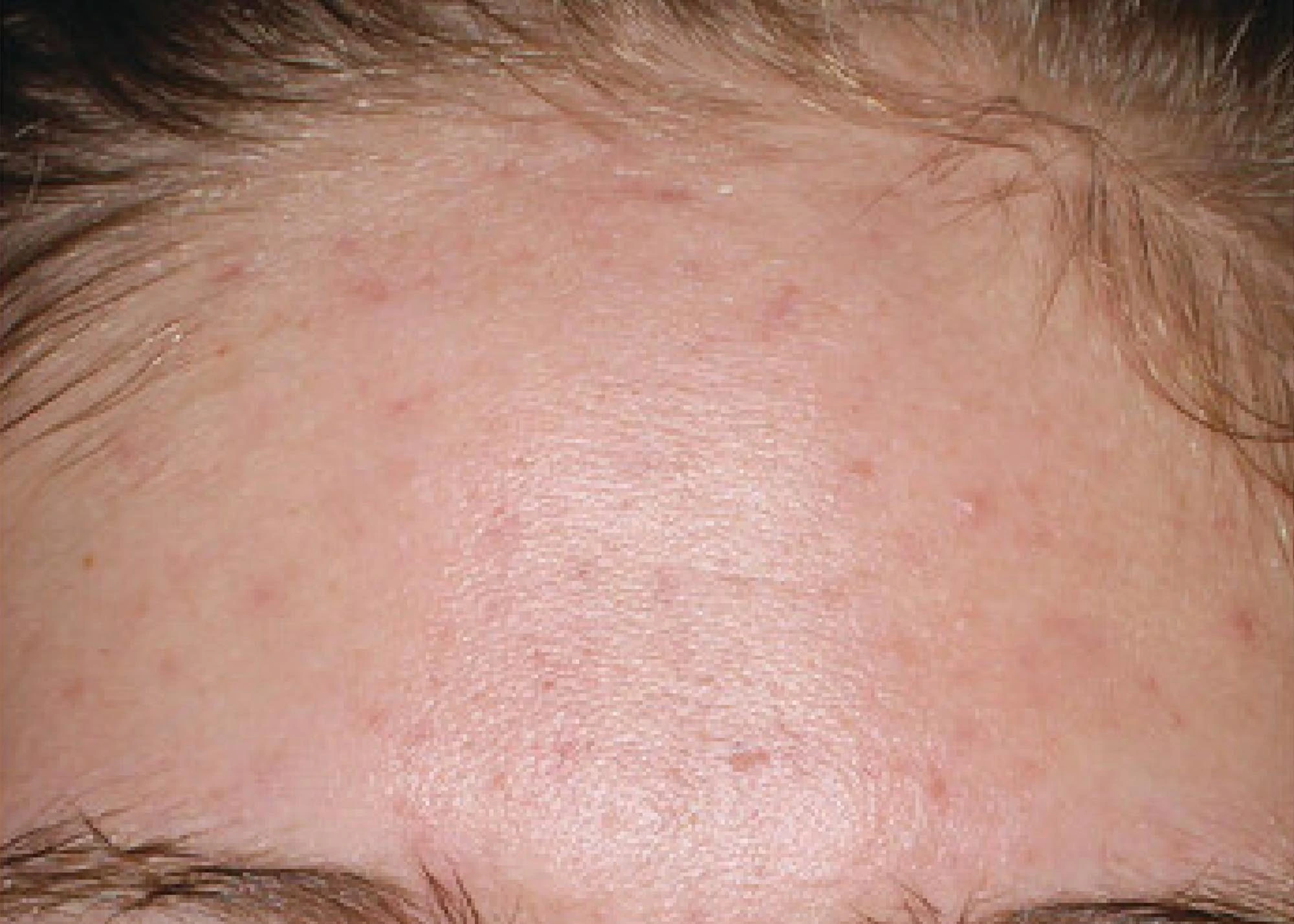 Before and after treatment results photos at The Face & Body MediSpa of Environ treatment